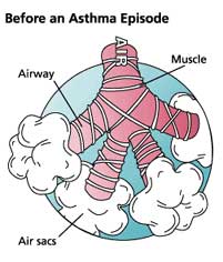 asthma episode